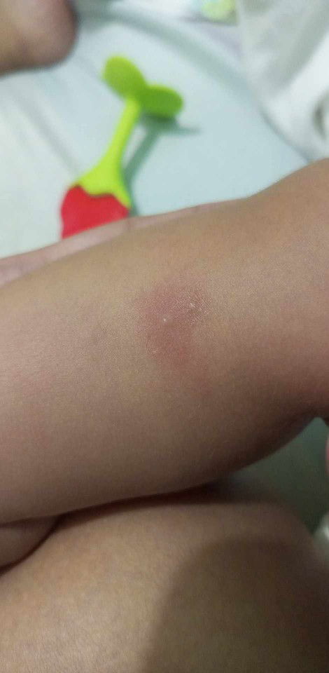 Ano tawag at saang galing ang ganitong tumubo sa katawan ng LO ko.