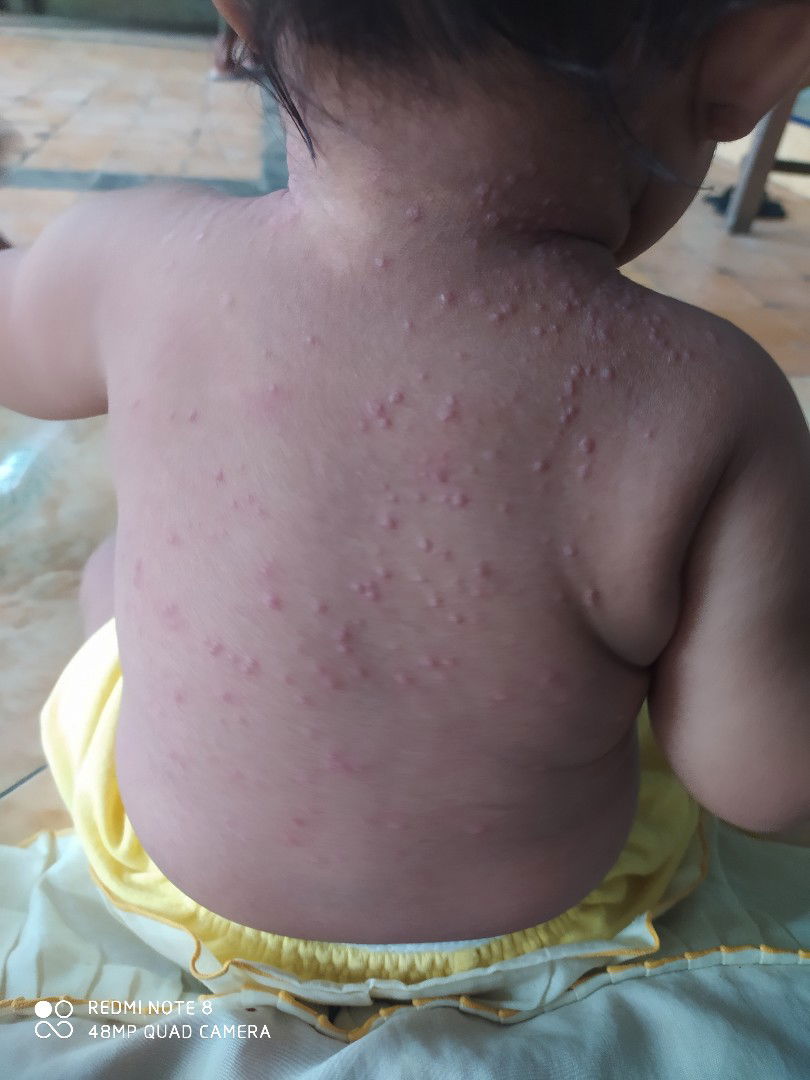 alergi atau biang keringat