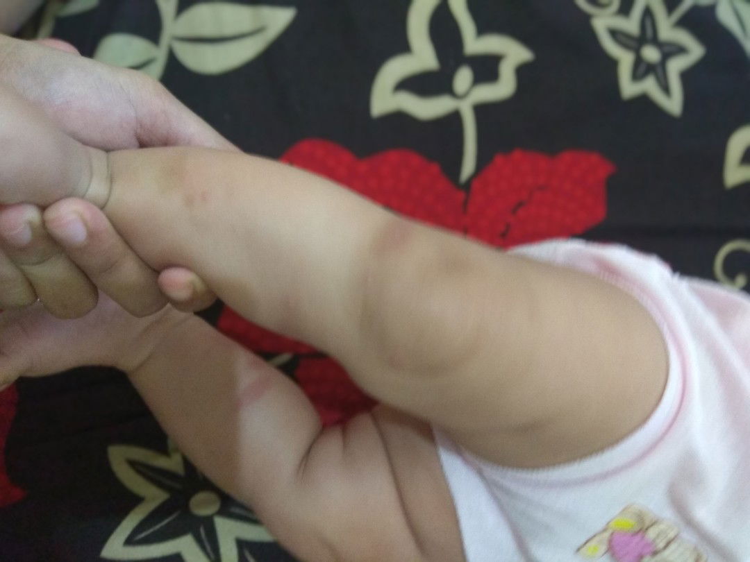 Obat Bentol Merah Pada Bayi