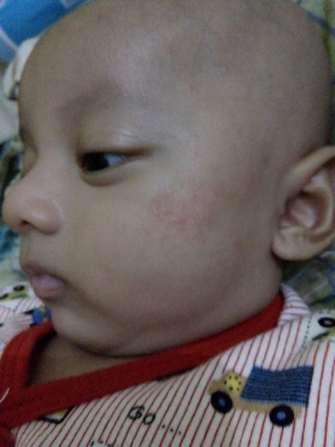ruam merah di pipi
