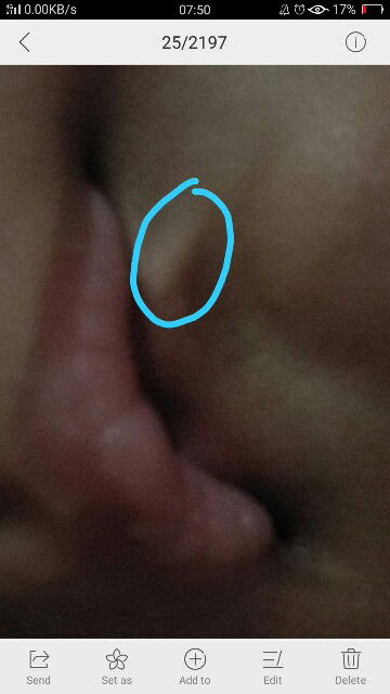 benjolan bawah bibir