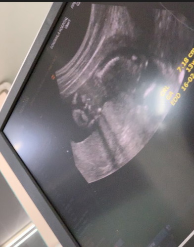 อัลตราซาวด์