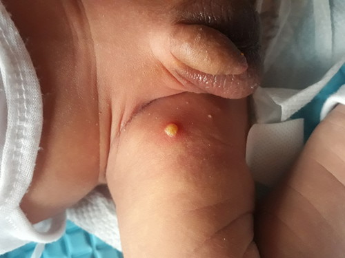 Rashes??