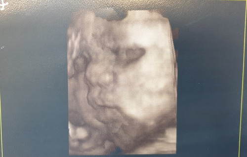 เบาหวานระหว่างตั้งครรภ์