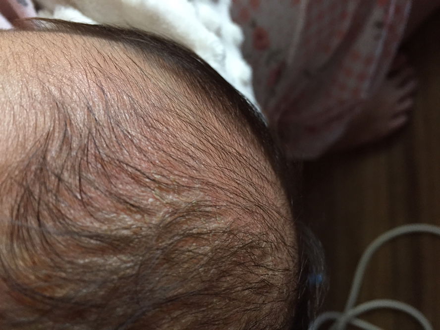 cara menghilangkan kerak kepala bayi umur 2 bulan gimana ya bun?