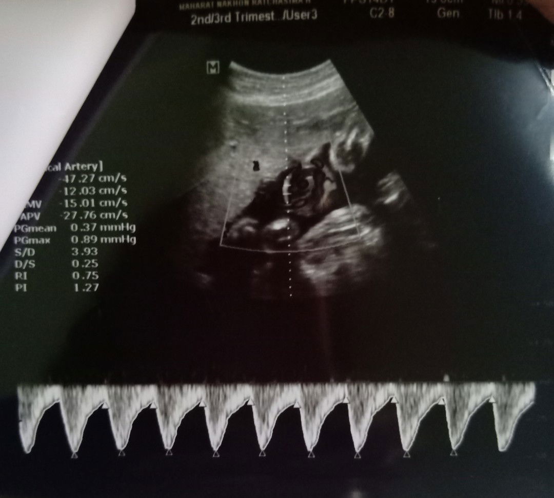 แม่บ้านไหนลูกในท้องตัวเล็กบ้างคะ ช่วยแชร์หน่อย