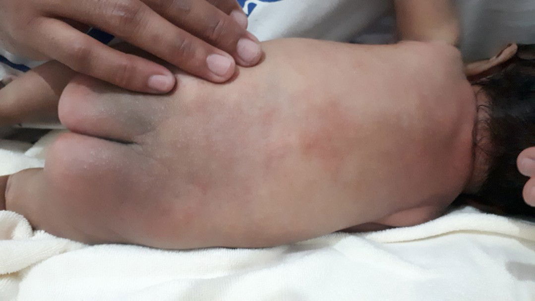 punggung sampe bokong mrintisi merah usia 40 hari