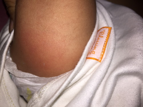 Bengkak Bekas Suntik DPT