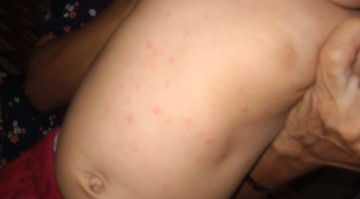 Alergi susu sapi atau bukan?