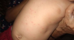 Alergi susu sapi atau bukan?