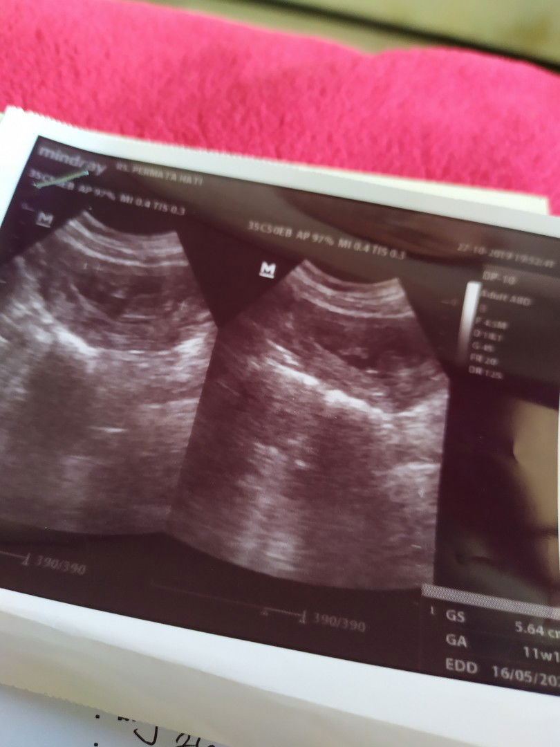 USG - Plasenta dibawah (placenta previa)