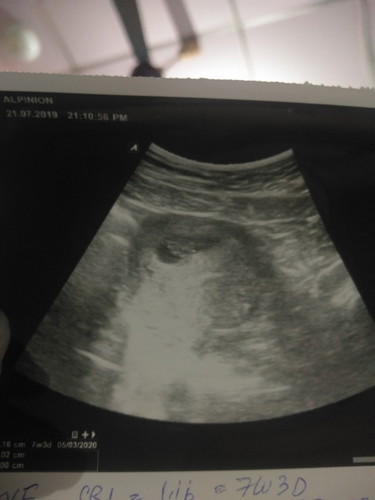ไปซาวดูน้องมา..หมอบอกน้องได้7สัปดากับ3วันแล้วที่น่าตื่นเต้นไปฝ่านั้นคือ..คุนหมอบอกมีสิทได้ลูกแฝด