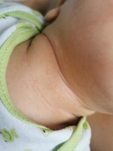 Rashes