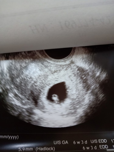 อัลตร้าซาวด์ผ่านช่องคลอด เจอตัวลูกแต่ไม่เห็นการเต้นของหัวใจ