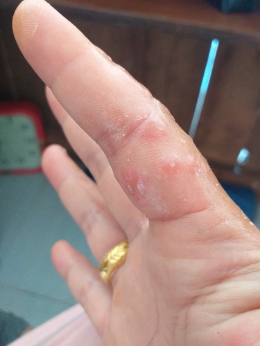 เป็นตุ่มคันที่มือ
