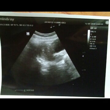 Alhamdulillah kehamilan pertama saya