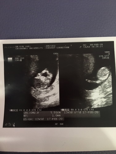 คัดกรองดาวน์กับอจาะเลือดคะ