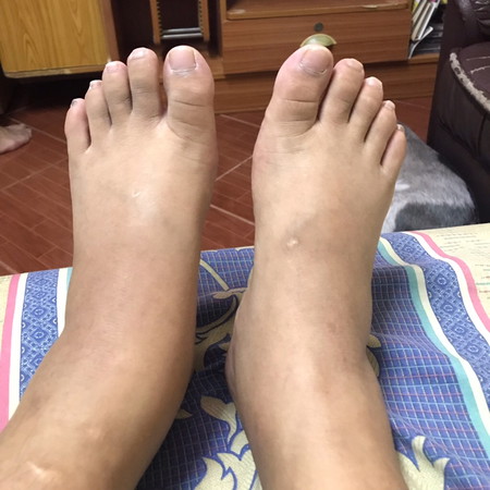 เท้าบวมเปงอะไรไหม