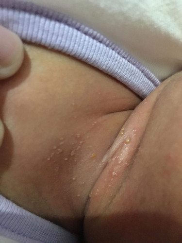 rashes