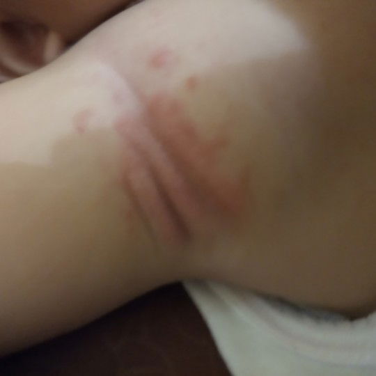 biang keringat kulit sensitif