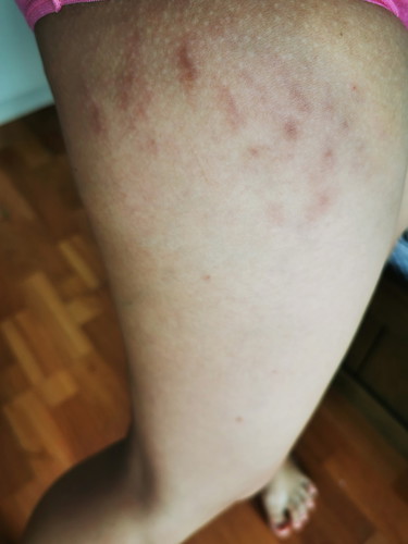 Dark Marks Due To Pregnancy