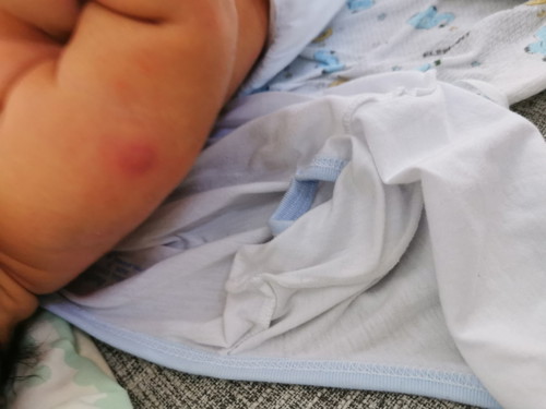 Kagat Po Ba Ng Lamok?