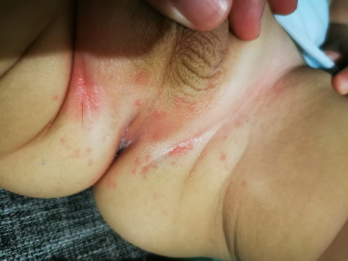 Rashes