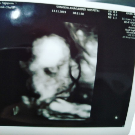 23w5dรกยังเกาะต่ำทำให้น้ำคร่ำน้อย