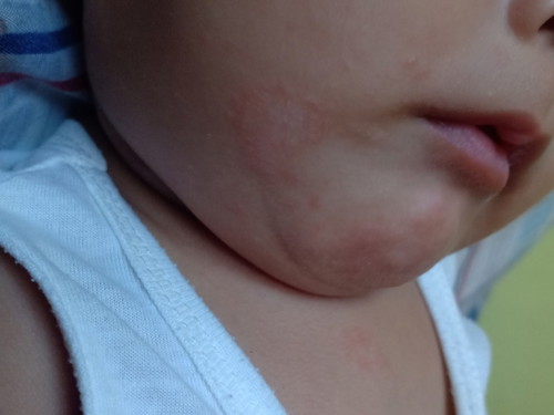 HELP PO! Skin ni baby ☹️