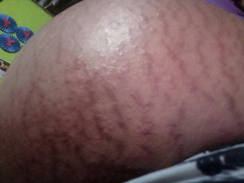 36w1d itchy baby bump