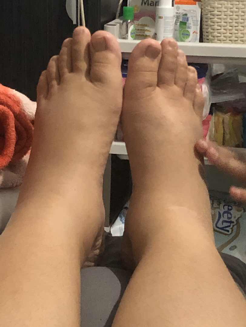 abis sc malah kaki bengkak
