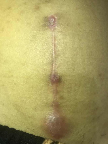 Csection wounds swollen