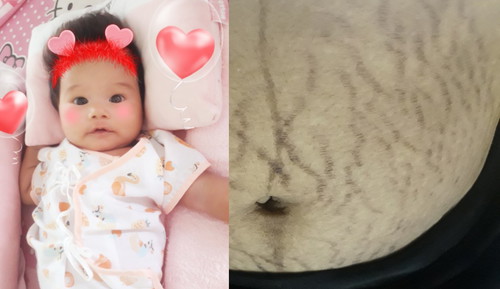 ท้องแตกลายยย แลกกับ เจ้าตัวน้อยที่ได้มา?