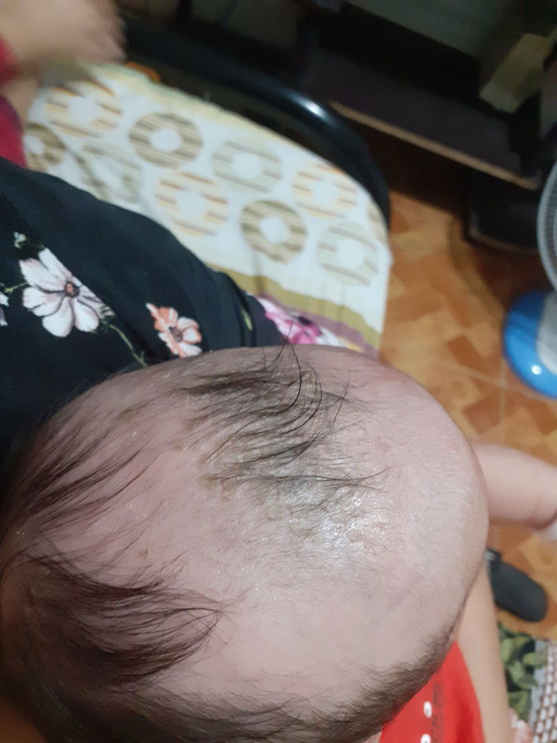 cradle cap