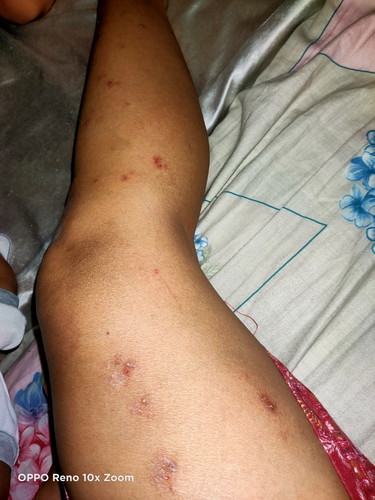Bad itchy rashes