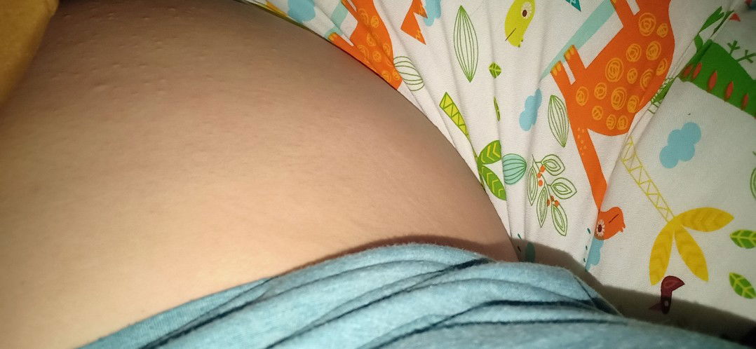 gatal bruntusan di perut