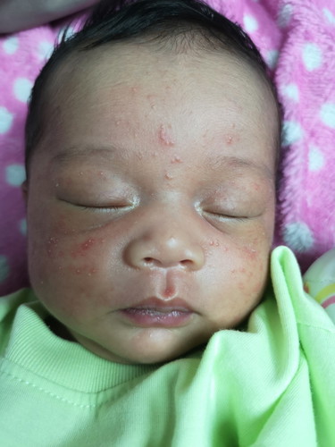 ผดขึ้นหน้าลูก