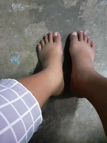 เท้าบวม