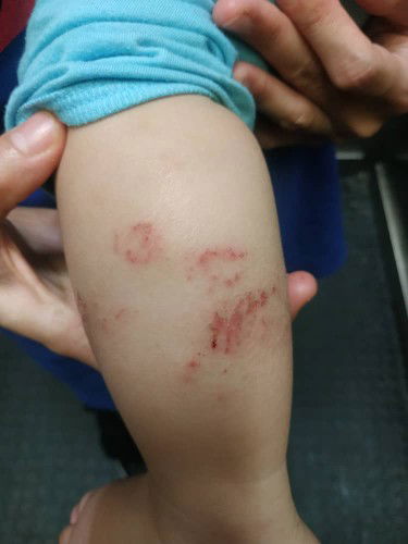 Pernah Tak Anak Kena Ringworm @ Fungus @ Kurap😭😭 Ada Tips Tak Selain Krim Klinik Bagi? Tq