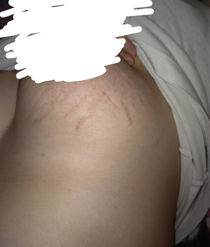 Underboobs Stretchmark