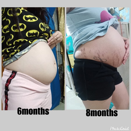 STRETCH MARK