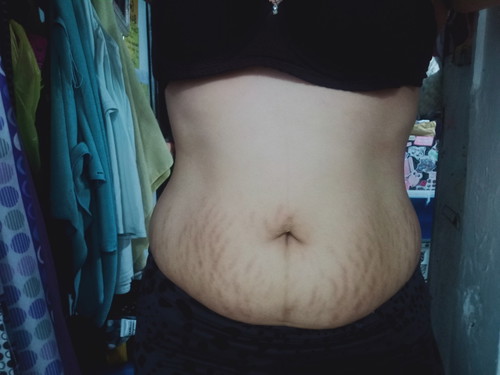 Stretch marks and belly fat