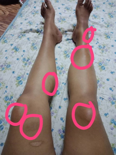 ขาช้ำเป็นก้อน