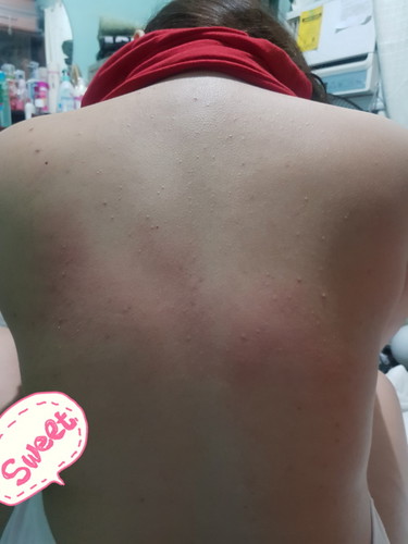 Back Acne