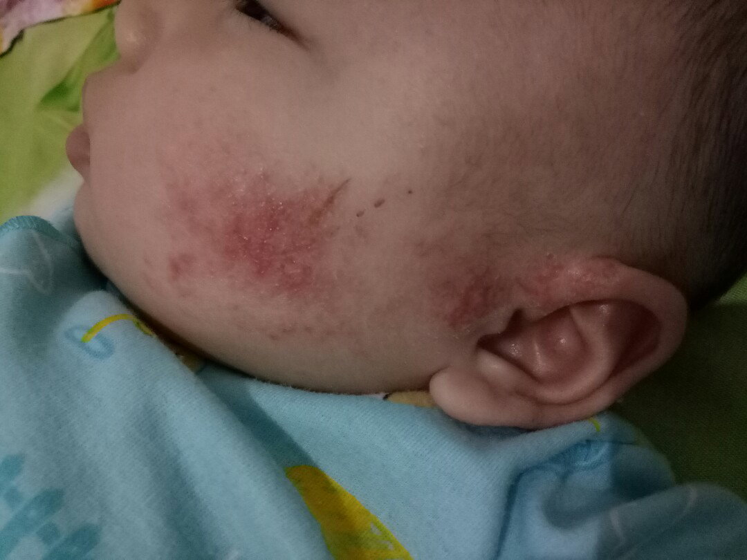 Dermatitis Atopik