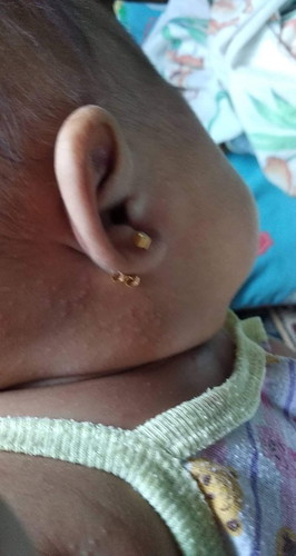 3 month old baby rashes