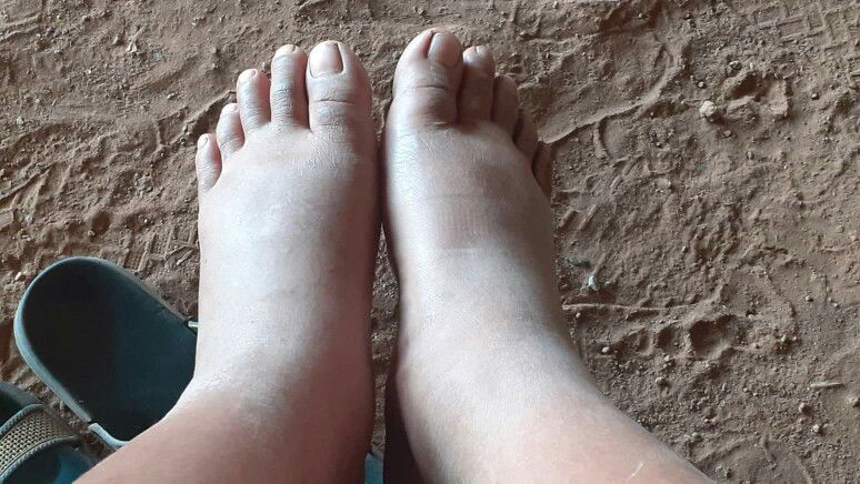 เท้าบวม