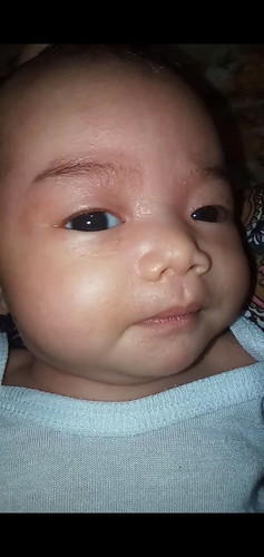 May Tumutubo sa Mukha ni Baby