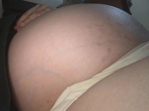 Stretchmarks @ 36weeks