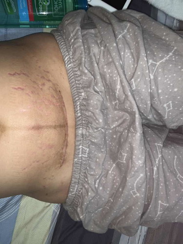 Stretchmarks